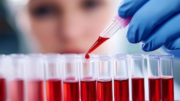 Results in preclinical studies suggest that inhibiting galectin-1 could slow the progression of fibrosis in patients with myelofibrosis. Clinical trials must be done to prove it (Illustrative Image Infobae)